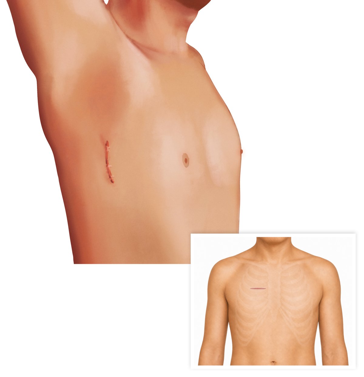 Trans-axillary incision hidden beneath the arm, with the smaller anterior right-thoracotomy incision used in selected cases